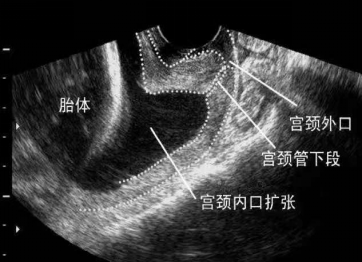 淄博市妇幼保健院:宫颈机能不全是什么?孕期宫颈怎样