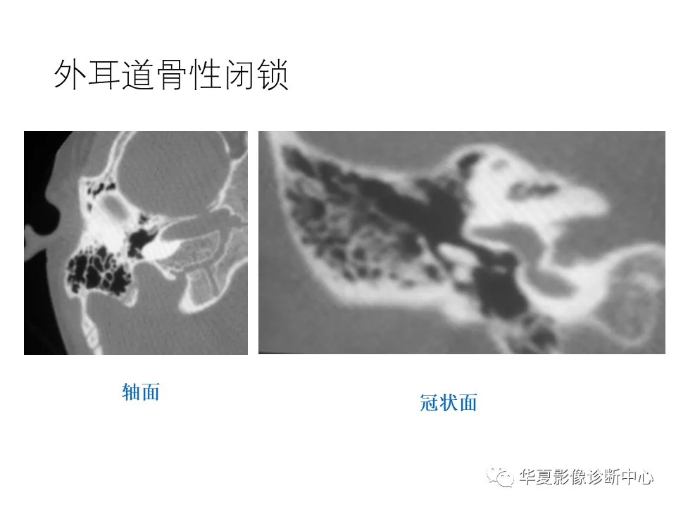 「学习必备」耳的影像解剖及常见疾病诊断