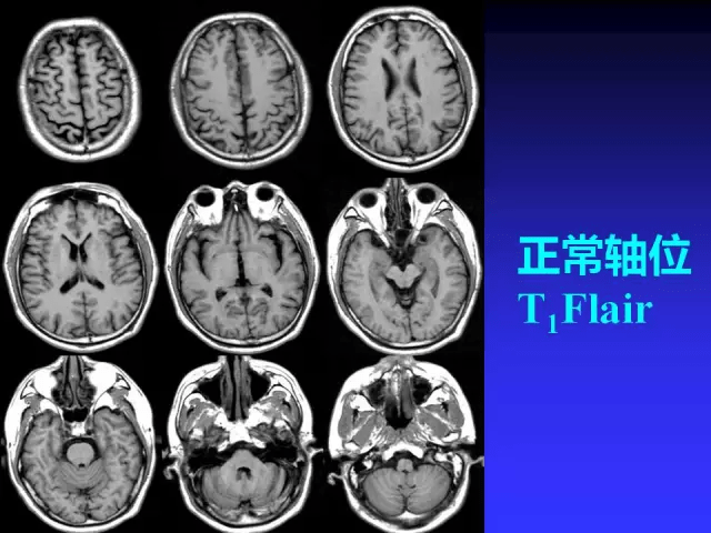 mr入门 | 头颅mri读片知识,需掌握