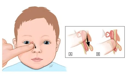2,按摩手法: 家长用食指或者小拇指,以适中的力度,按压在宝宝泪囊区