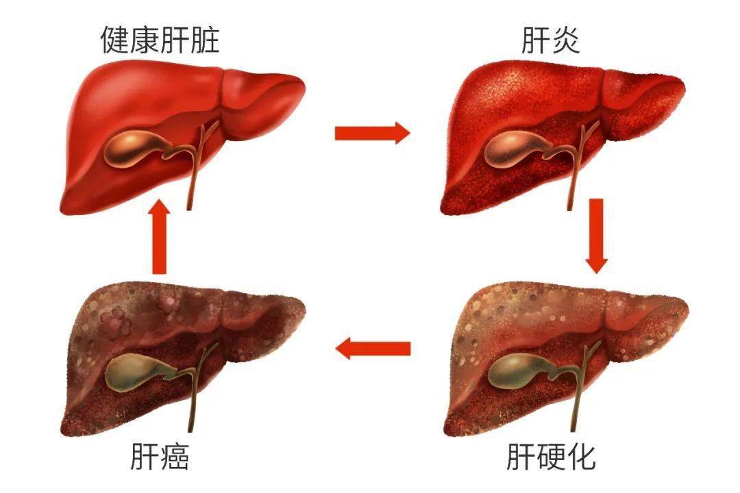 感染乙肝30年成肝癌,最后各项指标竟然正常了