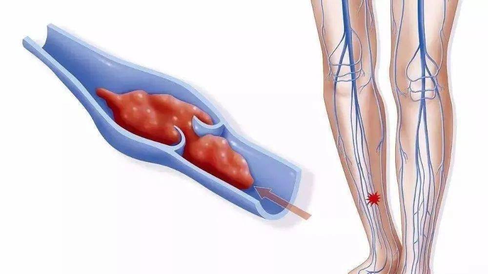 "深静脉血栓的形成主要有  血流缓慢,血管壁损伤及血液高凝状态三个