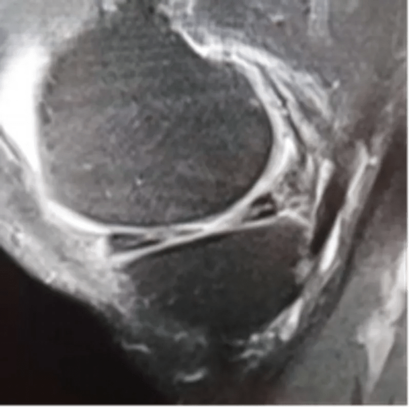 膝关节半月板病变的 mri 诊断与鉴别