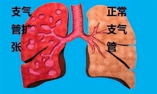 支气管扩张坚持中医治疗会取得良效