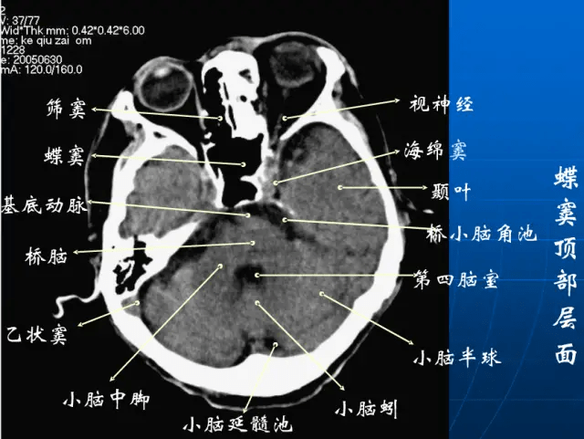 影像医生必须掌握的头颅ct解剖与常见出血梗死判读