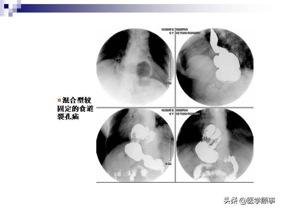 食道癌科普及影像分析