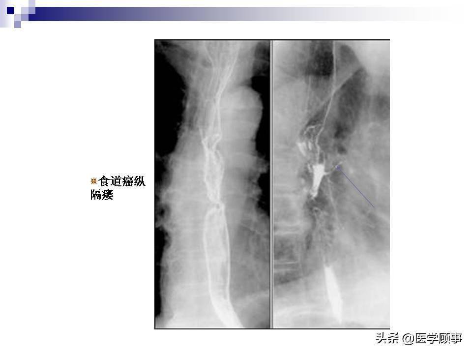 食道癌科普及影像分析