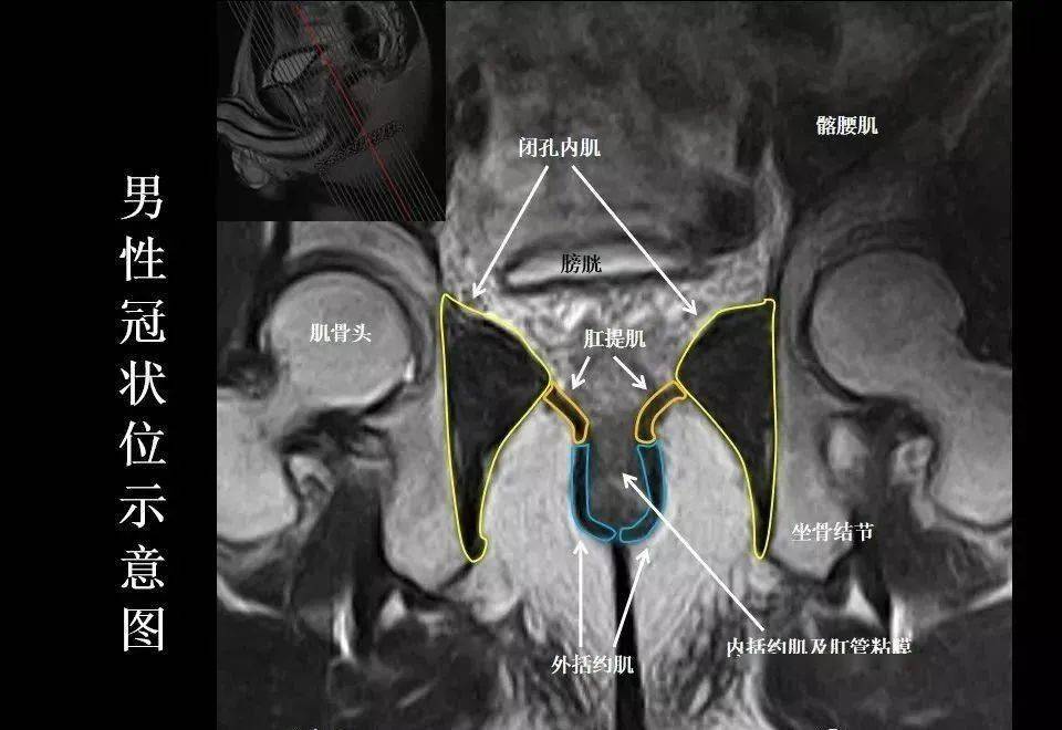 8张图带你熟悉盆底mri解剖