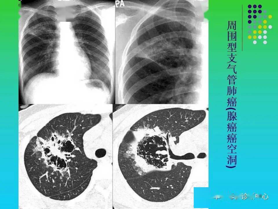 肺空洞性病变和囊性病变的ct诊断
