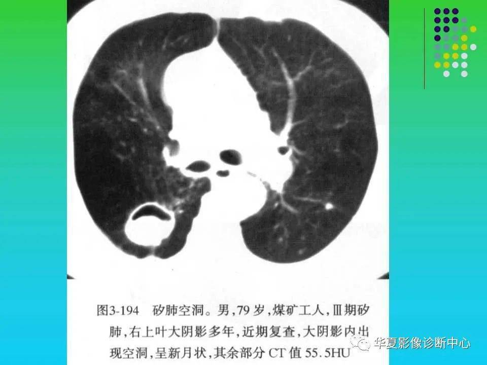 肺空洞性病变和囊性病变的ct诊断