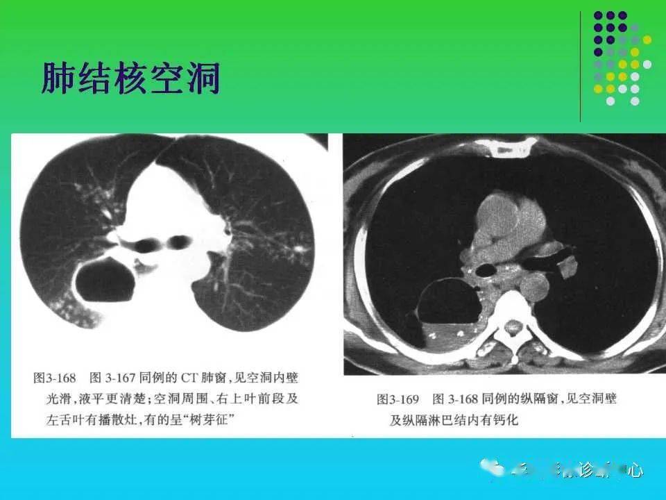 肺空洞性病变和囊性病变的ct诊断