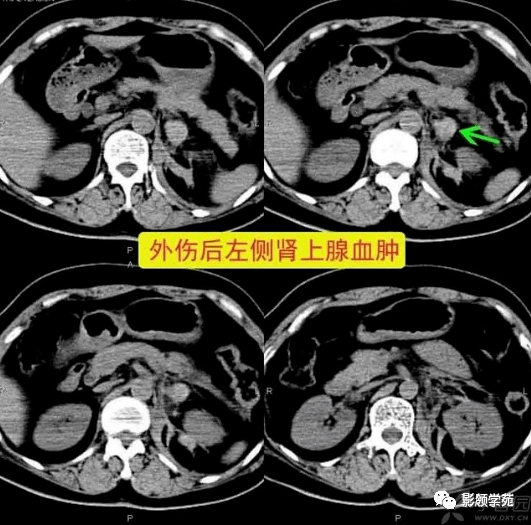 肾上腺病变的ct诊断