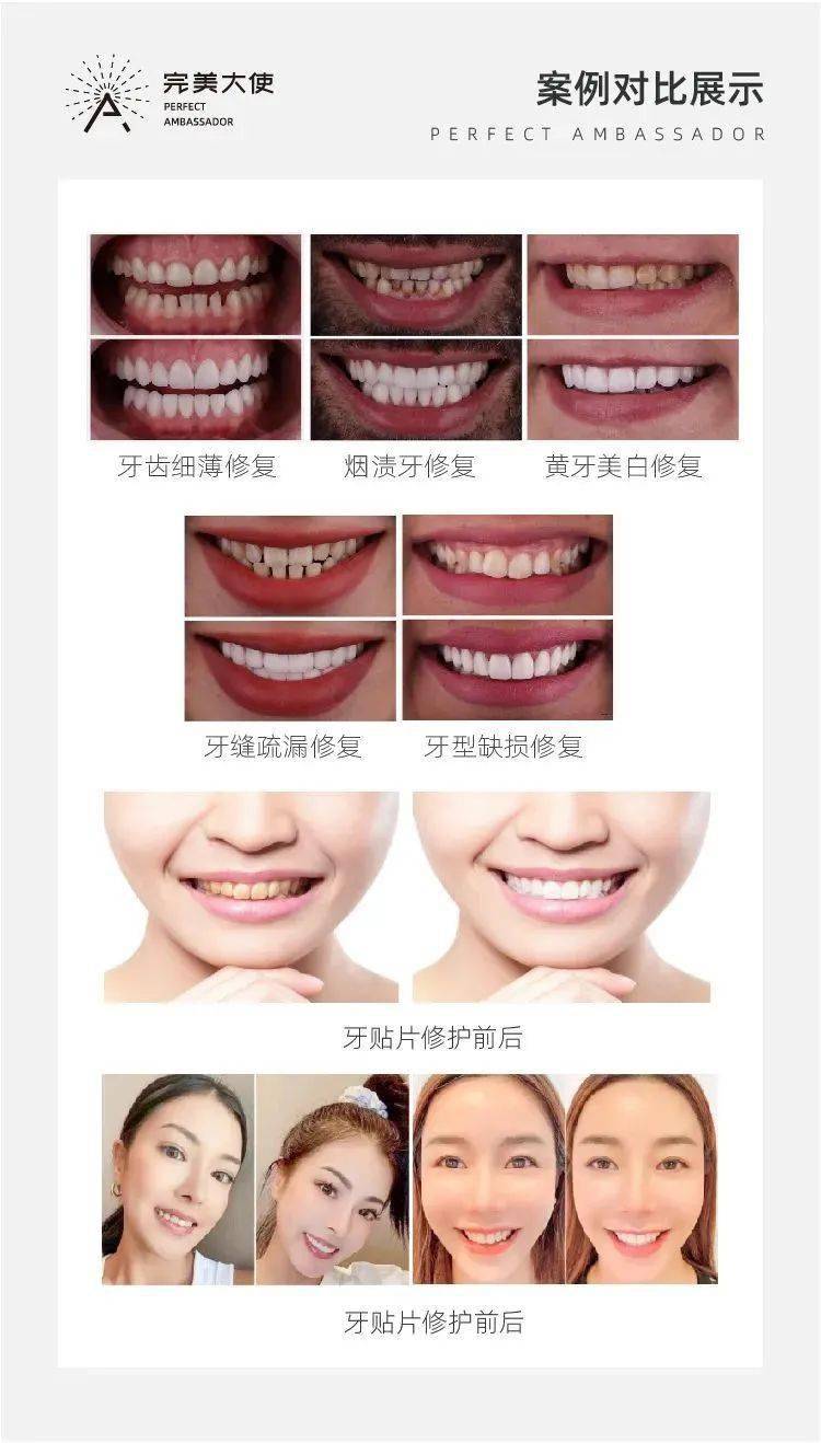 完美大使引进国际一线牙齿美学革新技术,严格依照国际口腔美学标准