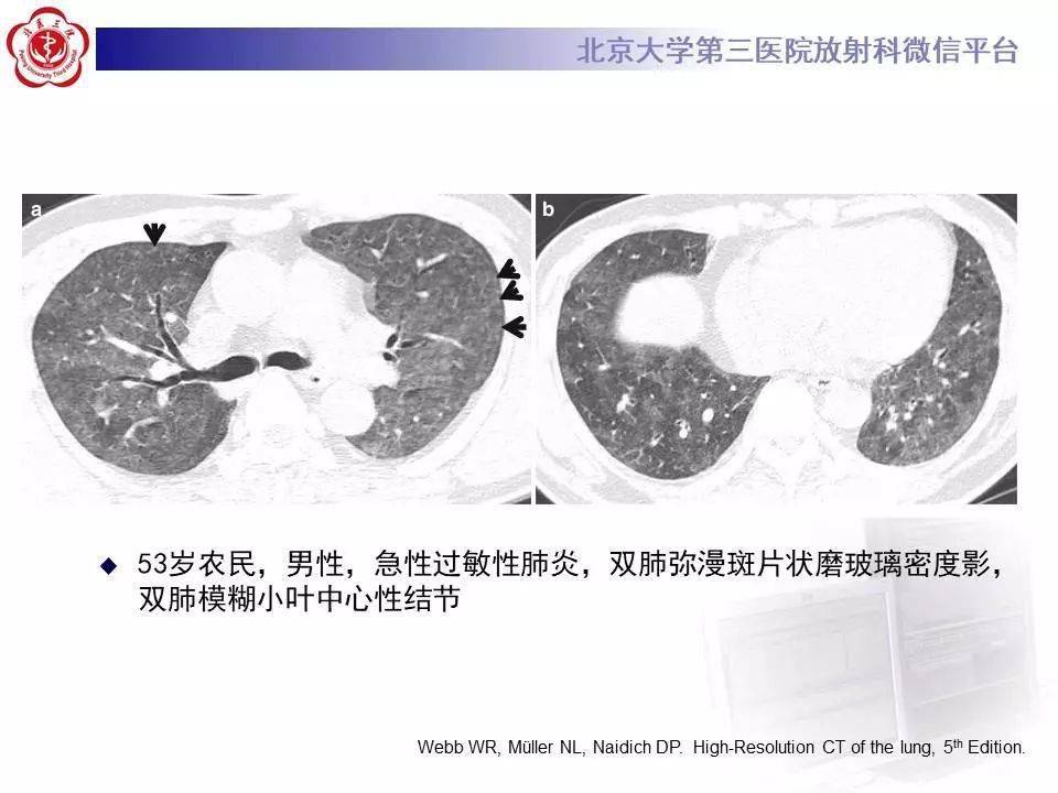 过敏性肺炎影像表现详细学习