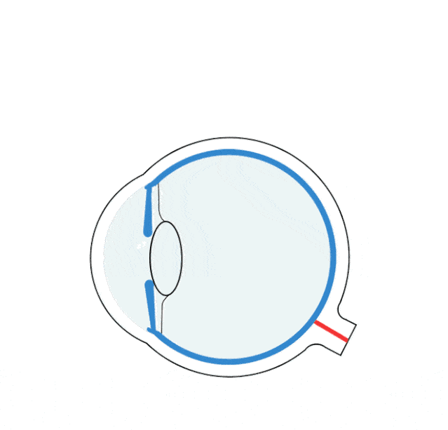 斜弱视检查包括眼肌运动检查,注视性质检查,三棱镜检查 02 | 炯 炯