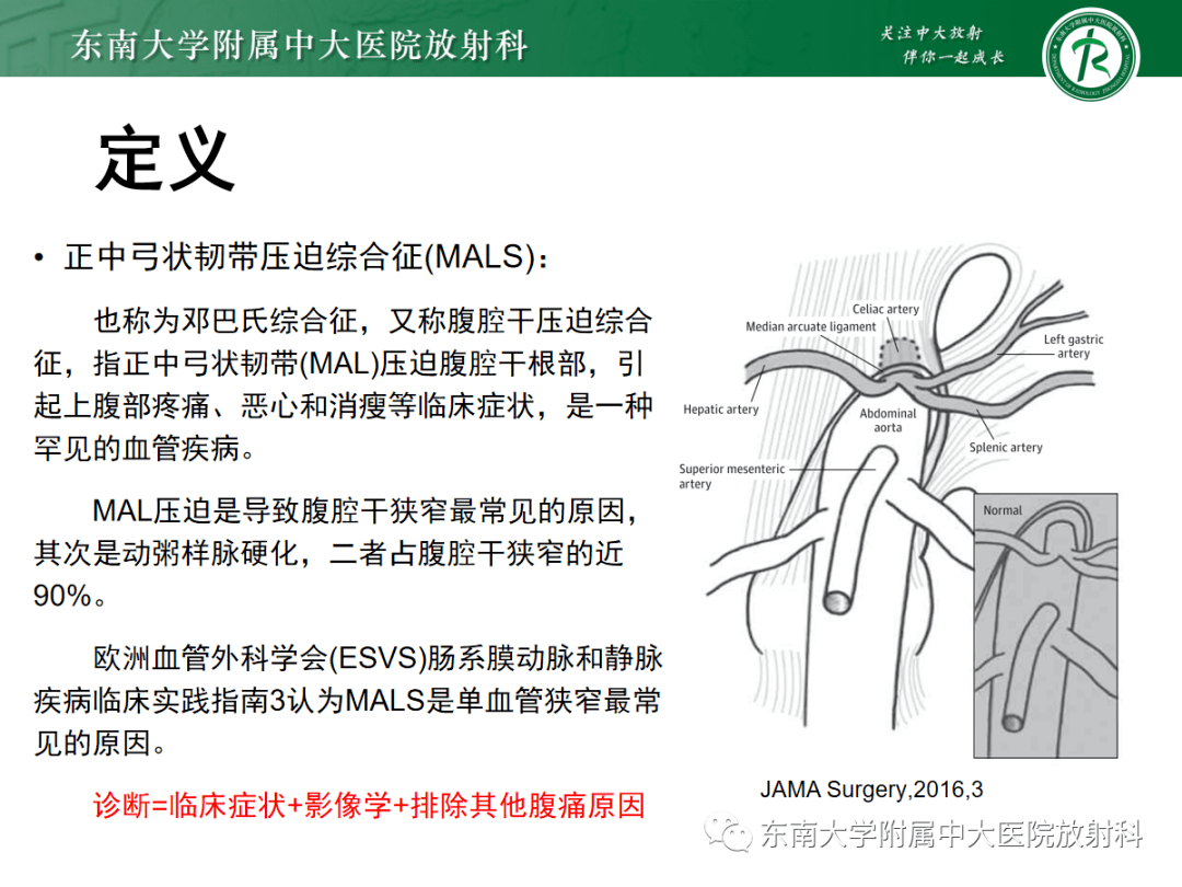 正中弓状韧带压迫综合征mals