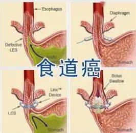 【健康科普】认识食道癌_肿瘤