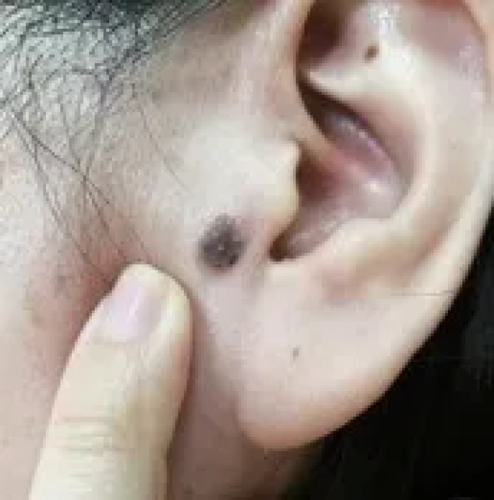 小心,这种"痣"可能是肝癌的信号!