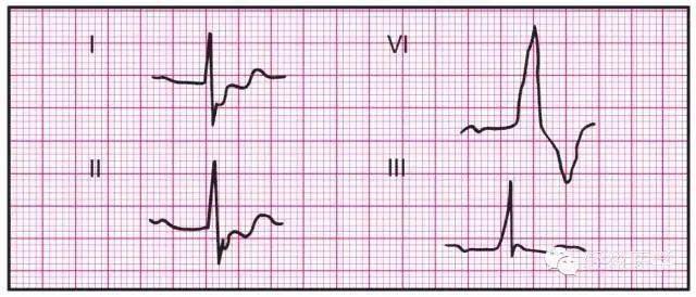 最全面的异常心电参考图,建议收藏!