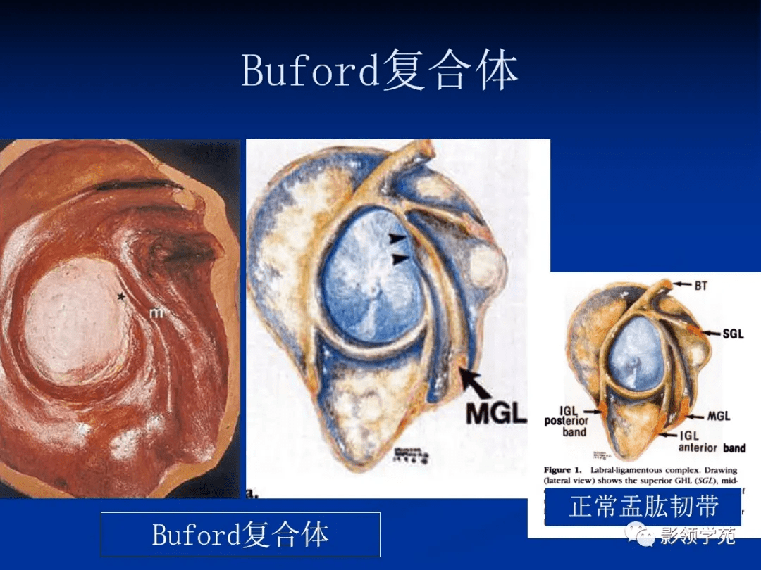 complex:又称 buford复合体或唇韧带复合体:是指索条状增厚的盂肱中