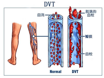 钓鱼"钓出"下肢深静脉血栓?