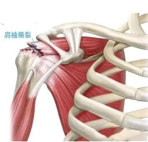 肩袖损伤与退变,血运,撞击和创伤有关—— 退变 肩袖的肌腱止点肌