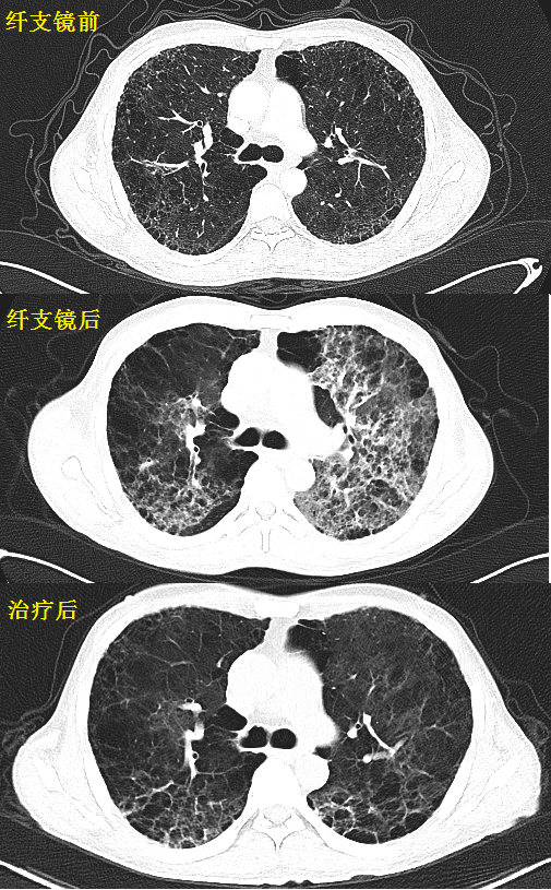 这份「肺纤维化 肺癌」读片秘籍,请收好