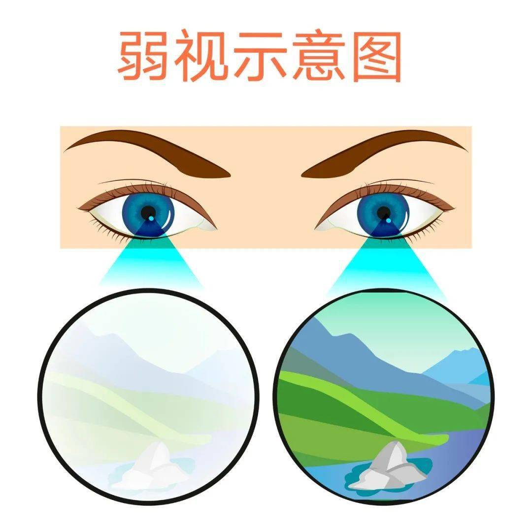 针灸治疗弱视?真的靠谱吗?_眼睛