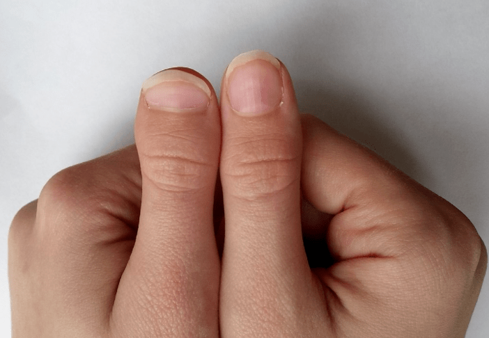 d型短指症多发于女性,而且还可能不对称:有些人只有一只手是短拇指.