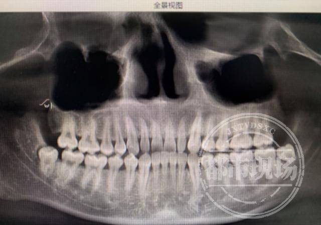 20多岁小伙智齿发炎,脸颊竟被脓肿穿破:里面全是