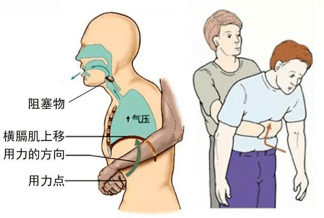老年人噎食的预防,互救和自救手册来了!速速收藏!
