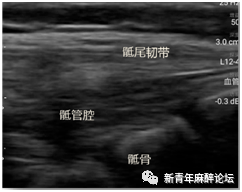 珠江视界 | 王儒蓉教授:超声引导骶管阻滞技术在肛周