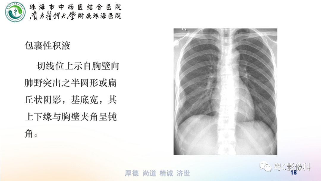 气胸胸腔积液肋骨骨折影像表现