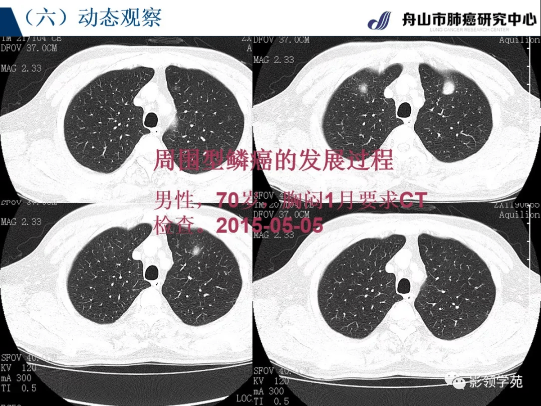 血管征 空气支气管征 ct征象小结:  所有征象认定均在ct三维重建基础
