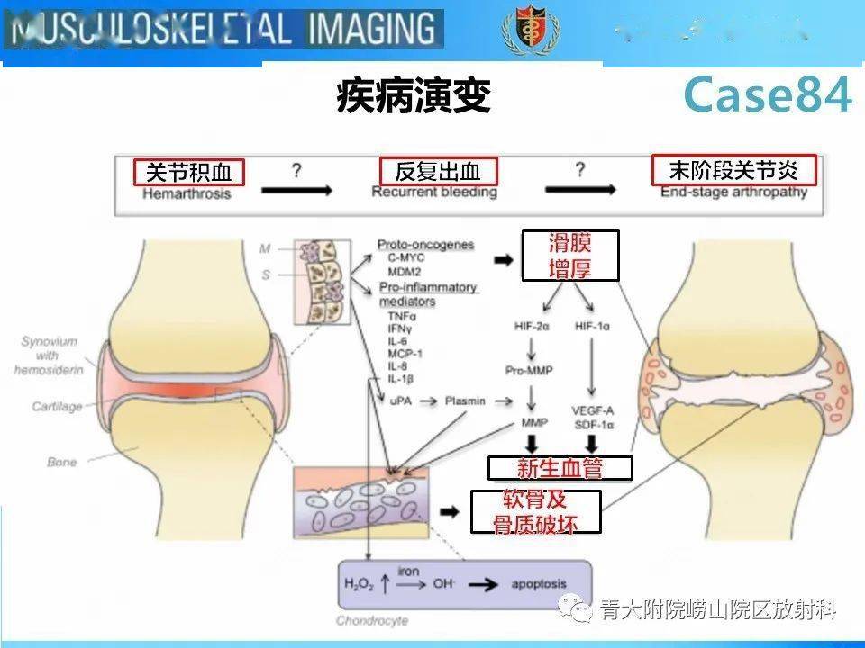 血友病性关节病