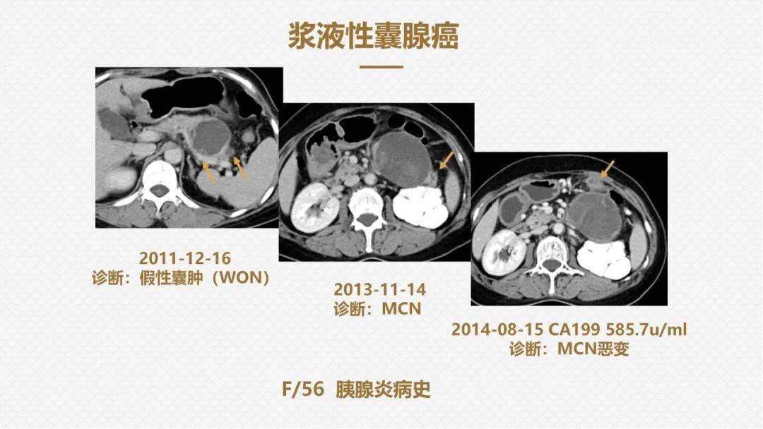 国人提出的囊外囊征象可以特异性诊断胰腺寡囊型浆液性囊腺瘤scn