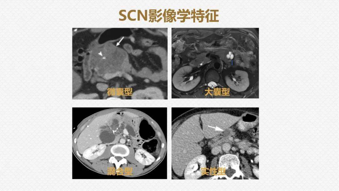 国人提出的囊外囊征象可以特异性诊断胰腺寡囊型浆液性囊腺瘤scn