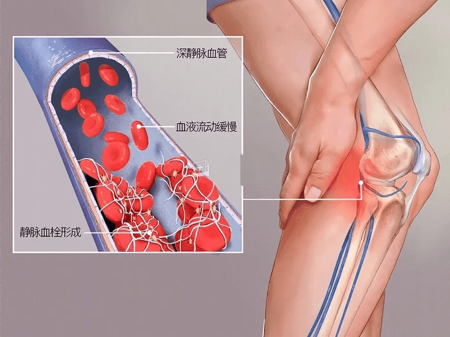 腿肿腿胀小心危及生命的静脉血栓快来了解预防