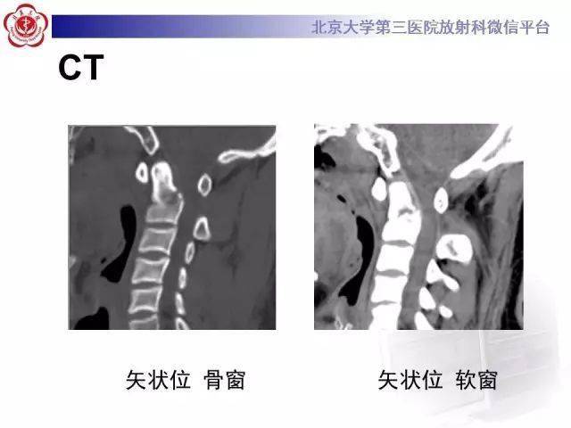 齿状突骨折分型