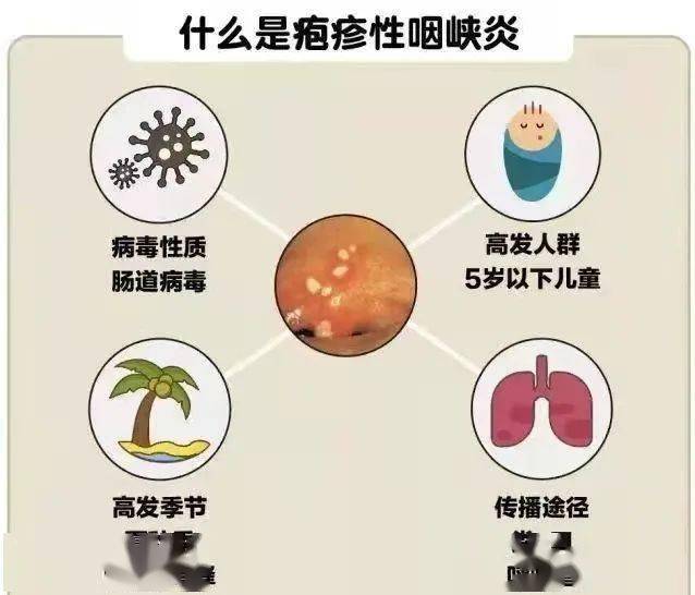 小儿疱疹性咽峡炎是柯萨奇a组病毒所致,好发于夏秋季,它是常见的一种