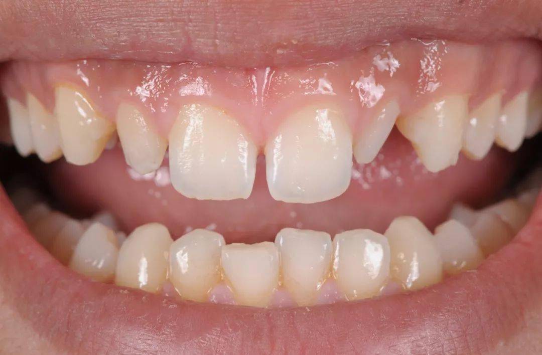 一位16岁的男性患者,临床表现为侧切牙过小牙,且22属于严重病例.