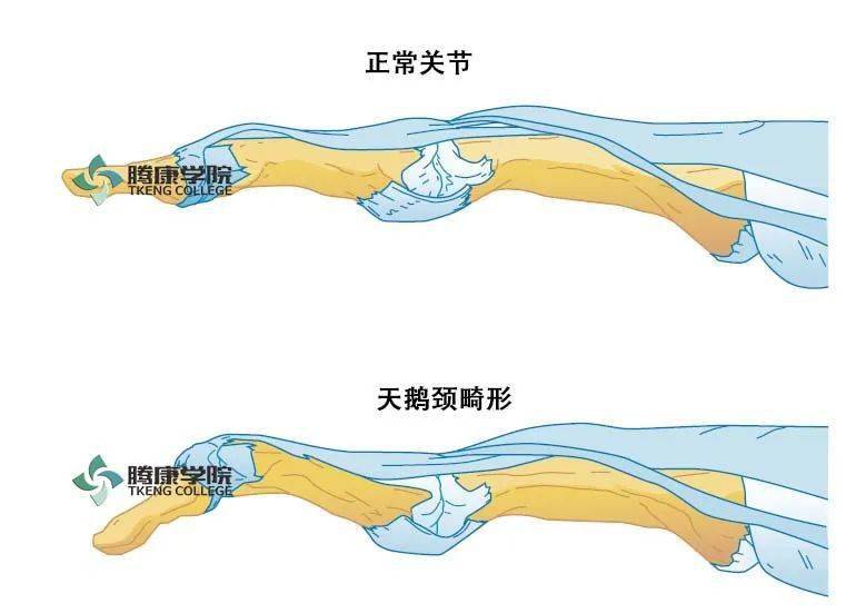 天鹅颈畸形包括近端指关节过伸,远端指间关节屈曲
