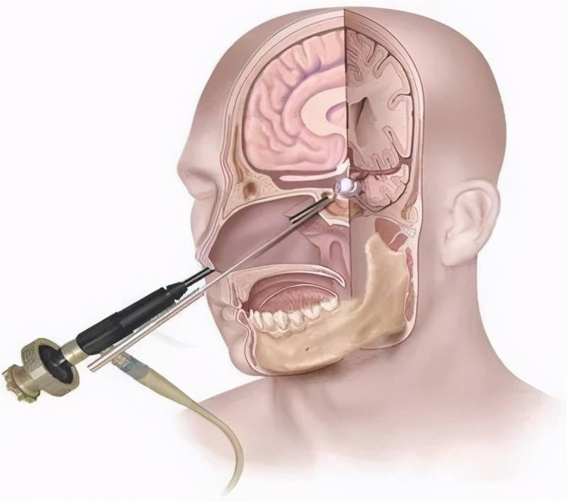 原来,垂体瘤处于接近头颅中心,颅底正中的位置,其在颅腔外的投影正好