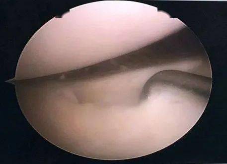 【诊疗动态】骨外科五病区完成一例关节镜下半月板缝合,关节腔清理术