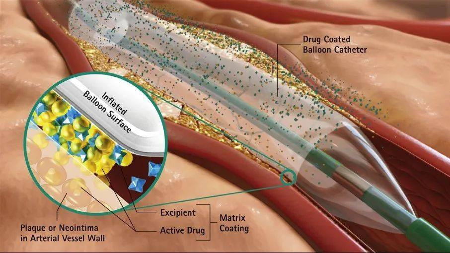 北京医院患者受益于药物涂层球囊技术实现介入无植入