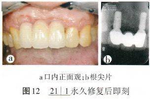 5效果追踪修复后7个月复查,业龈缘位置稳定,种植体周围未见骨吸收影像