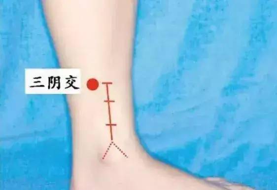 涌泉穴:最好能分型选穴湿热的体质:艾灸足三里,三阴交,涌泉穴,阴陵泉