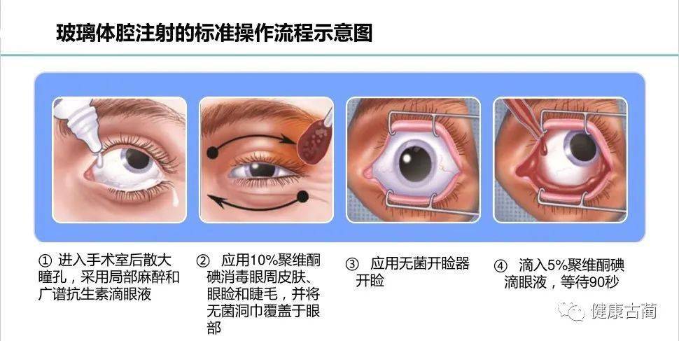 古蔺县人民医院成功开展全县首例玻璃体腔注药术开启眼底病治疗新篇章