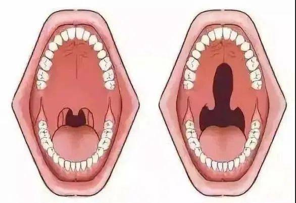 腭裂,隐藏在口腔内,没有唇裂直观,常被称为"狼咽.