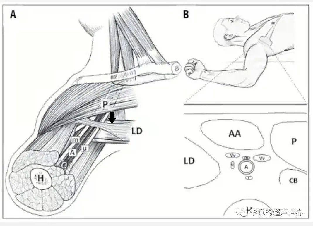 超声解剖61腋窝包块之朗格腋弓_神经